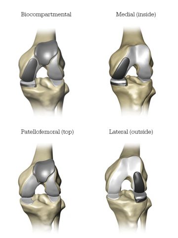 knee replacement surgery