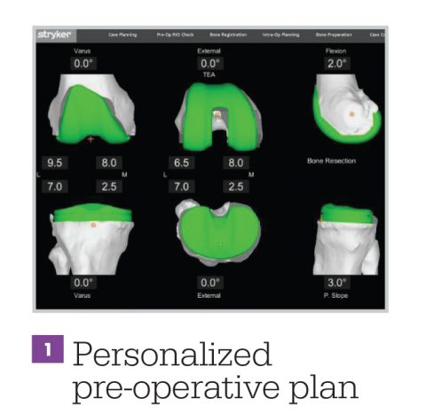 knee replacement joint plan