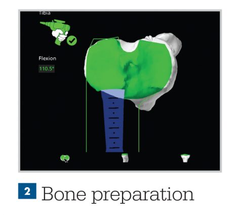 surgery for knee arthritis