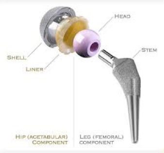 hip replacement surgery components