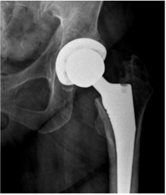 hip replacement surgery