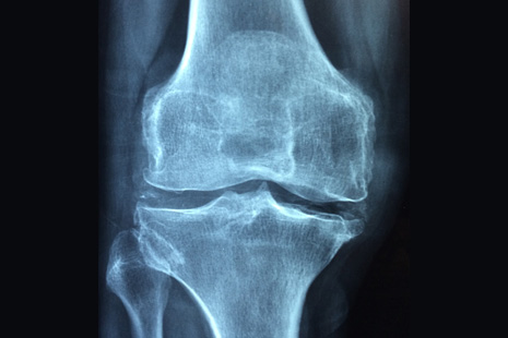 X-Ray image of a knee with knee pain