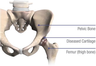 joint pain caused by hip arthritis and fixed with direct anterior approach