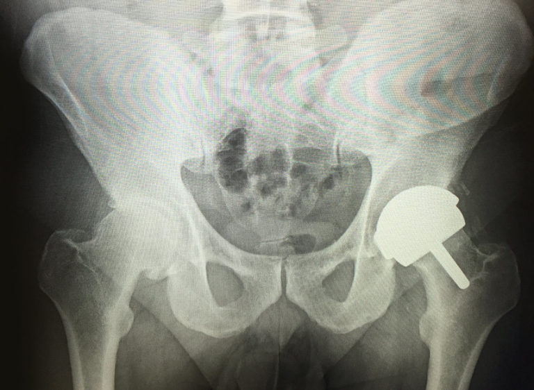 Hip Resurfacing Eau Claire, WI Dr. Nate Stewart, Chippewa Valley