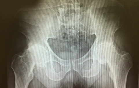 bilateral total hip arthroplasty